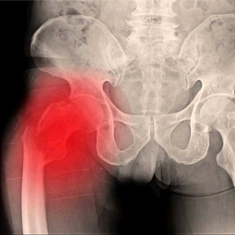Diabetes & Hip Fracture Risk – Why You Need to Care