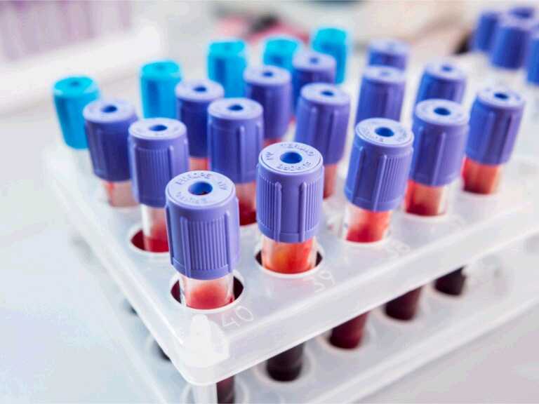 The 4 Standard Blood Tests for Diabetes